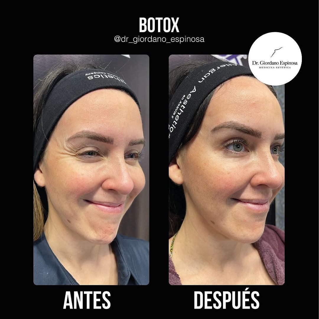 Botox