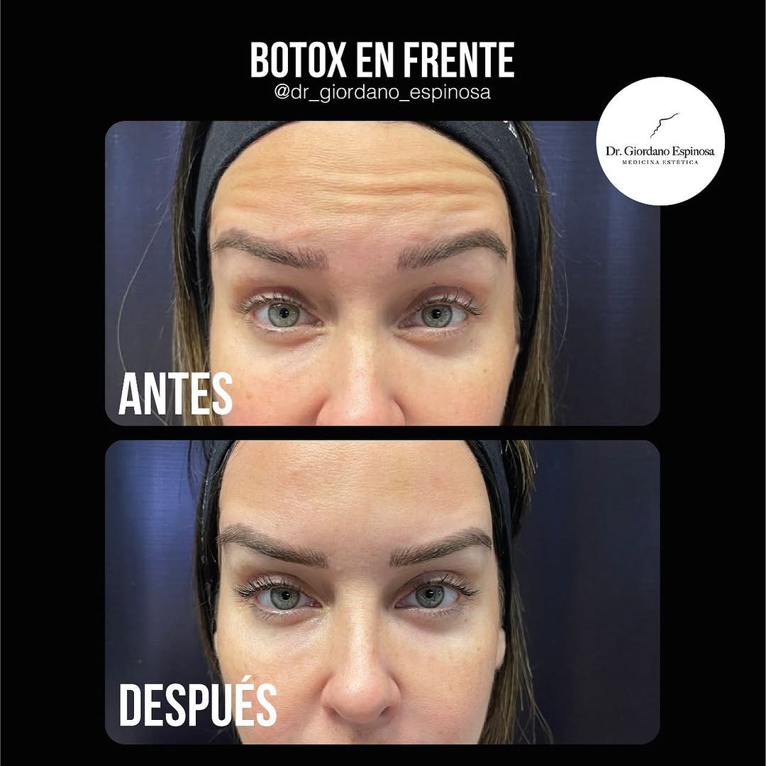 Botox resultado