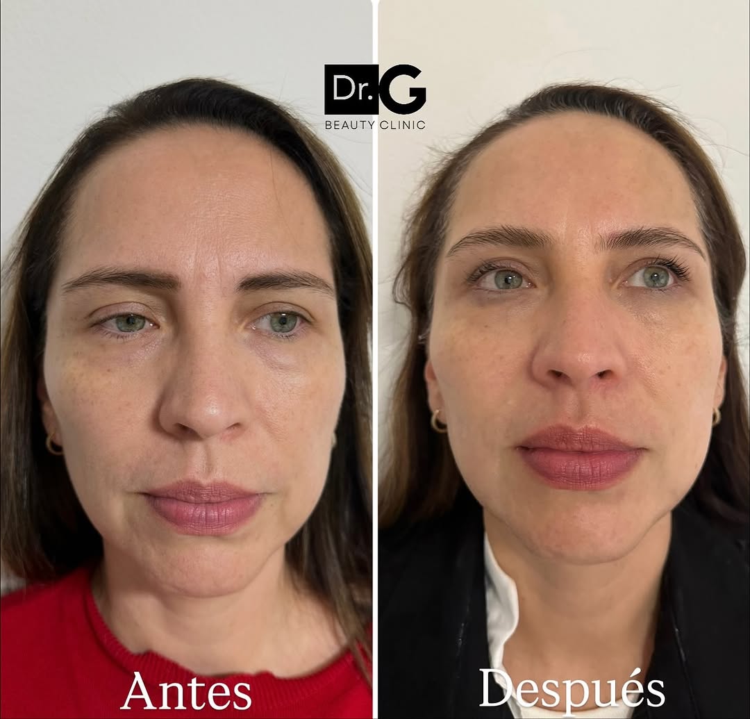 Liftera resultado